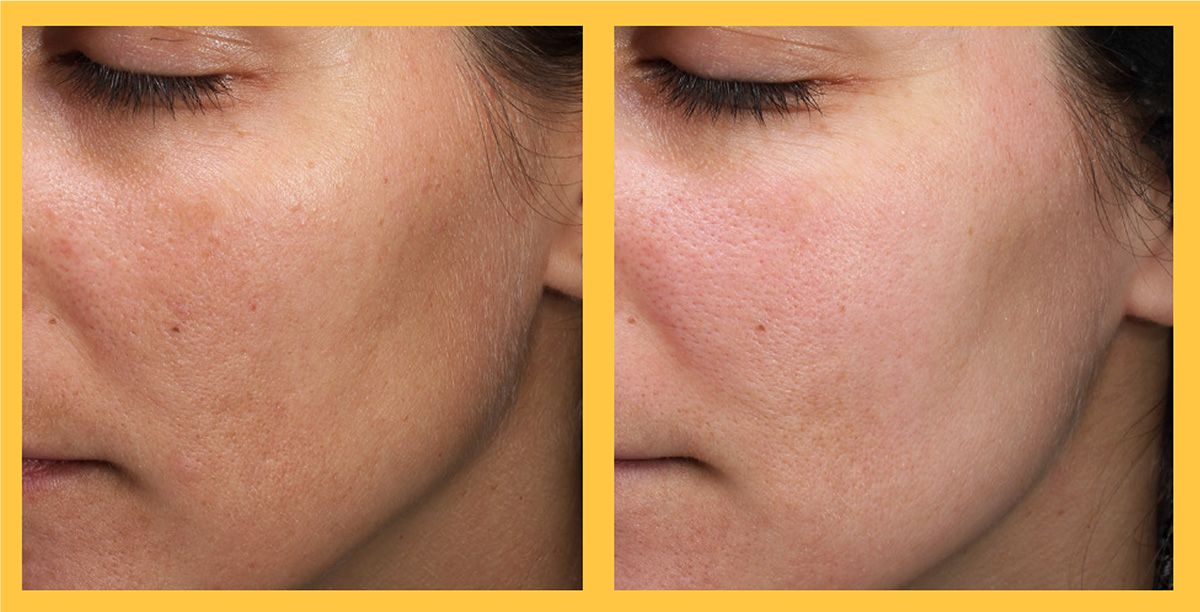 Before and After 3 Treatments of Level 2 MoxiTM