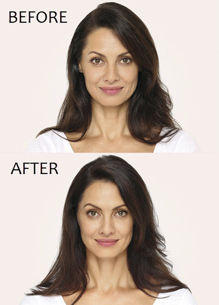Radiesse injectable filler, look younger in Naples, FL