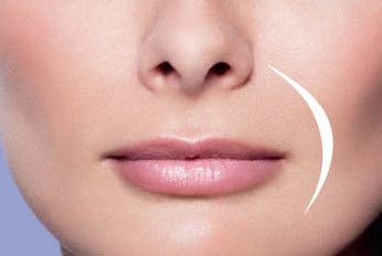 Juvederm Ultra Plus to smooth wrinkles