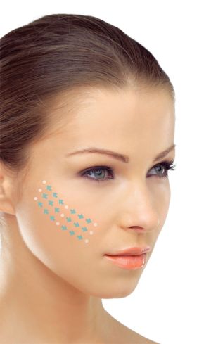 Silhouette non-surgical facelift anti-aging in Naples, FL