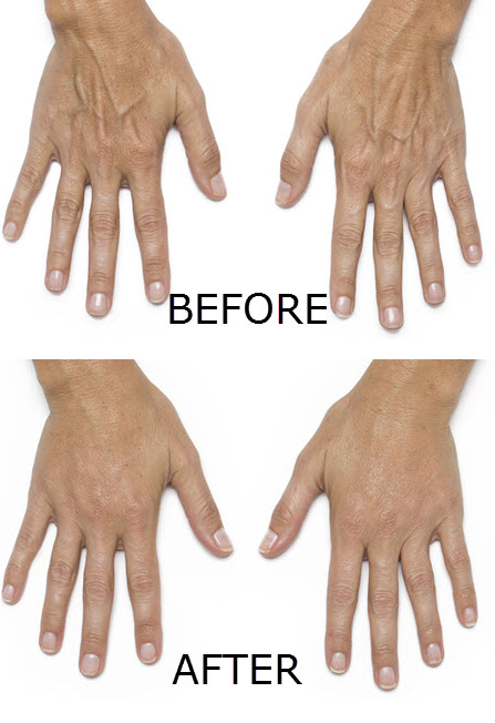 Younger looking hands with Radiesse treatment at out Naples Medspa