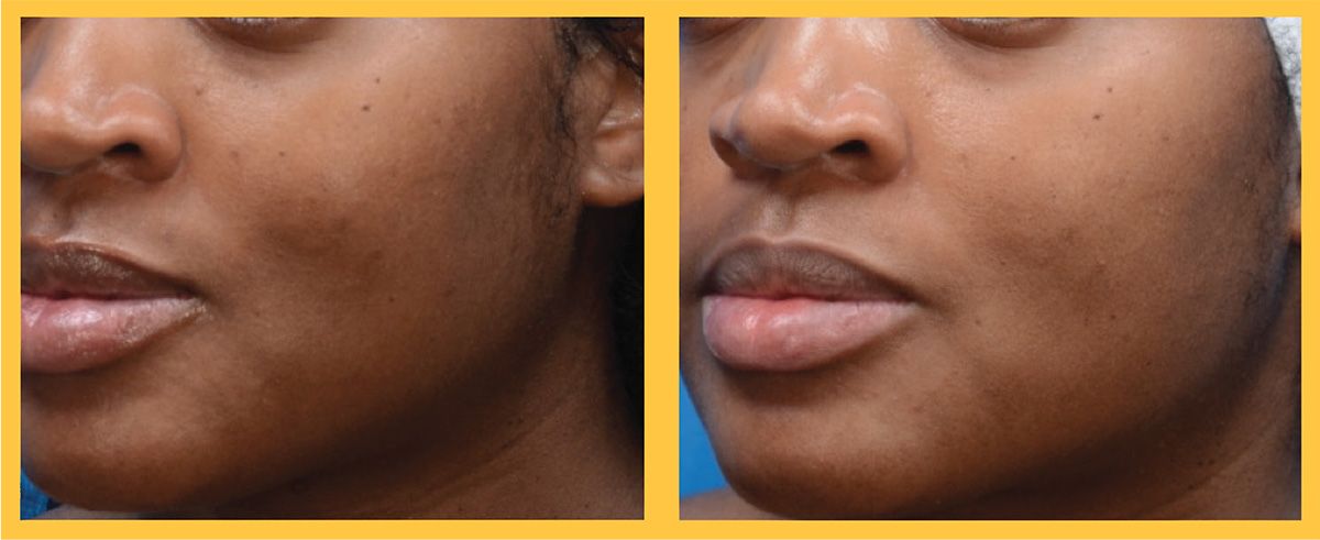 Before and After 1 Treatment of Level 1 MoxiTM