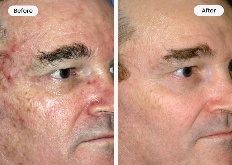 Contour TRL Before and After