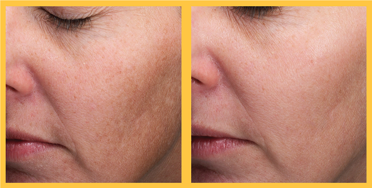 Before and After 3 Treatments of Level 2 MoxiTM