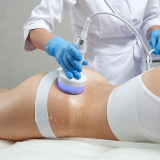 CoolSculpting Fat Freezing