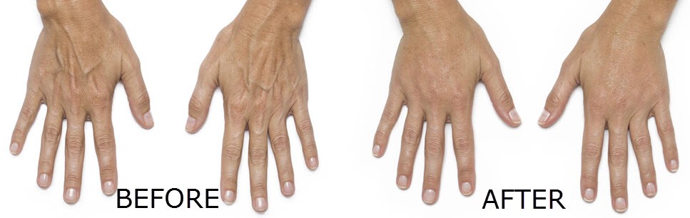 Hands Before and After Radiesse